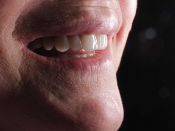 5 passos para cuidar das facetas de resina